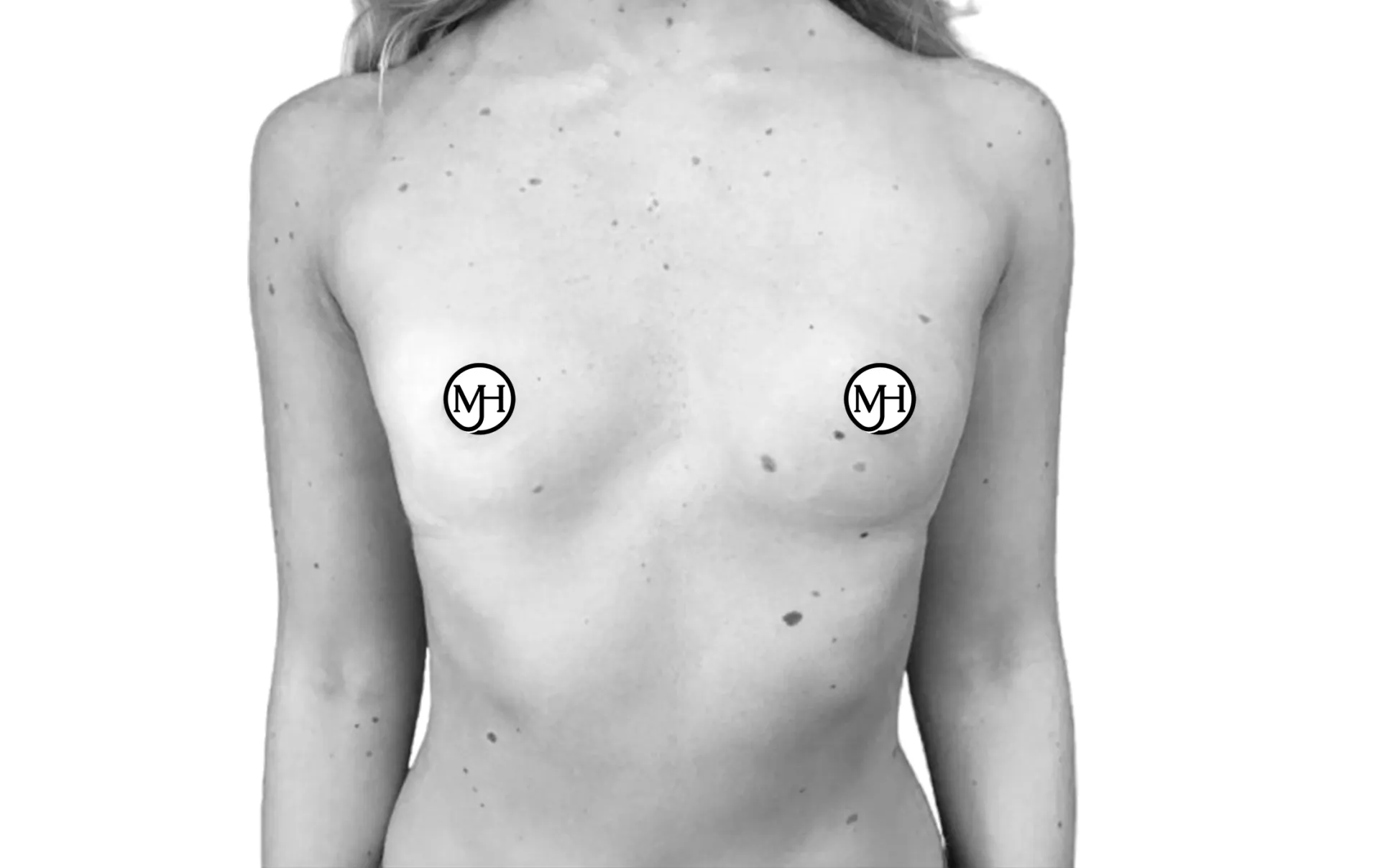Breast augmentation before: a patient's upper body from the front before the operation