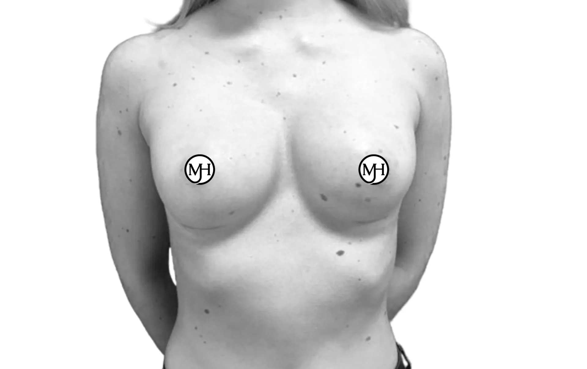 Breast augmentation after: a patient's upper body from the front after the operation