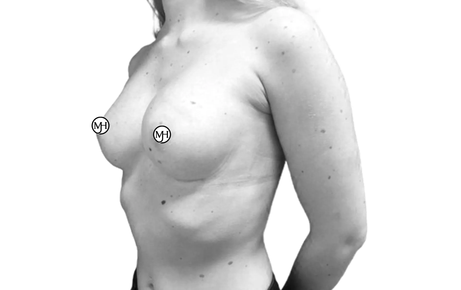 Breast augmentation with anatomical implants (360 cc) after, side view