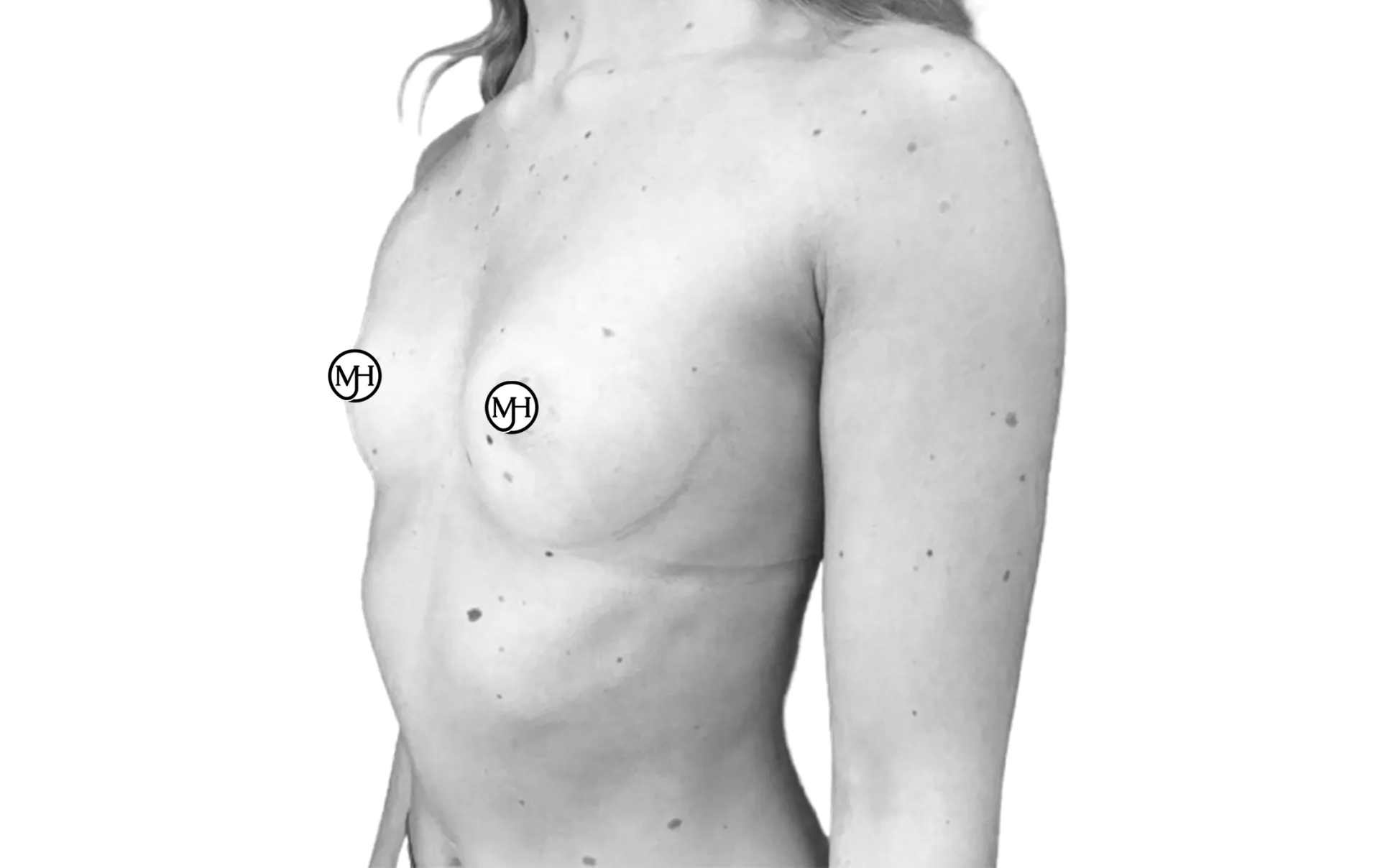 Breast augmentation with anatomical implants (360 cc) before, side view