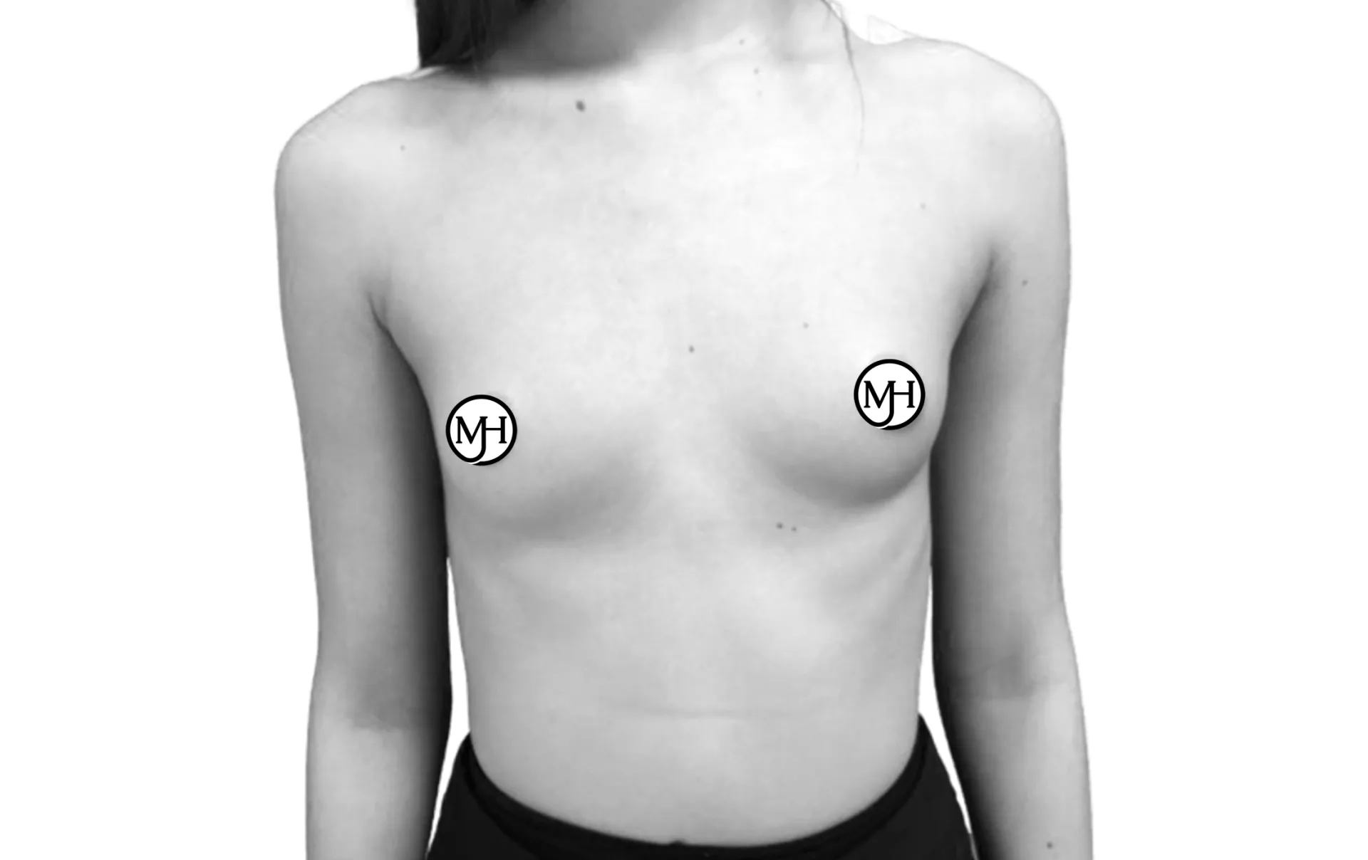 Breast augmentation with round implants (280 cc) before, front view