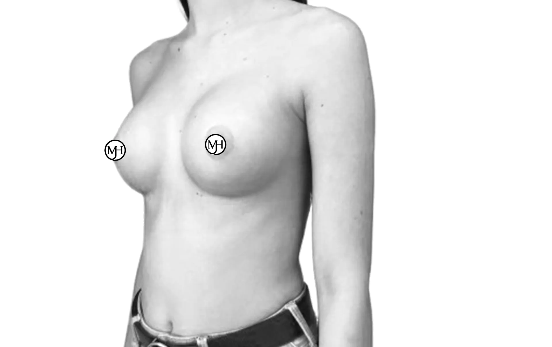 Breast augmentation with round implants (280 cc) after, side view