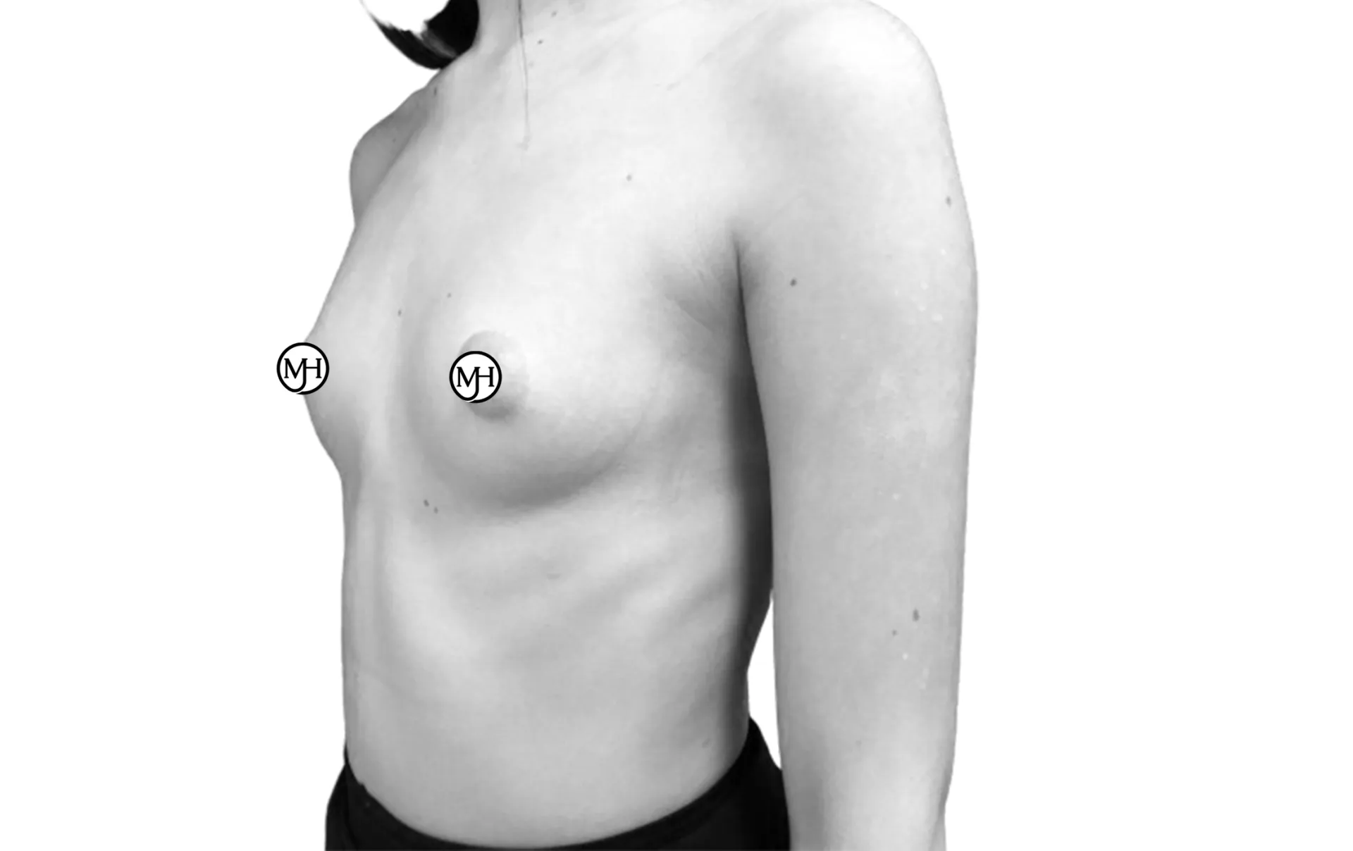 Breast augmentation with round implants (280 cc) before, side view