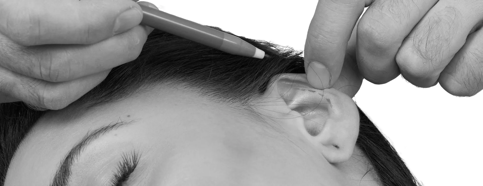 Stretched earlobe repair