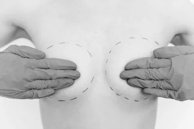 Gloved hands on a breast with markings drawn before a breast augmentation