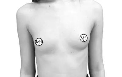 Minimum age for a breast augmentation